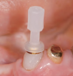 Kerator Locator Abutment System